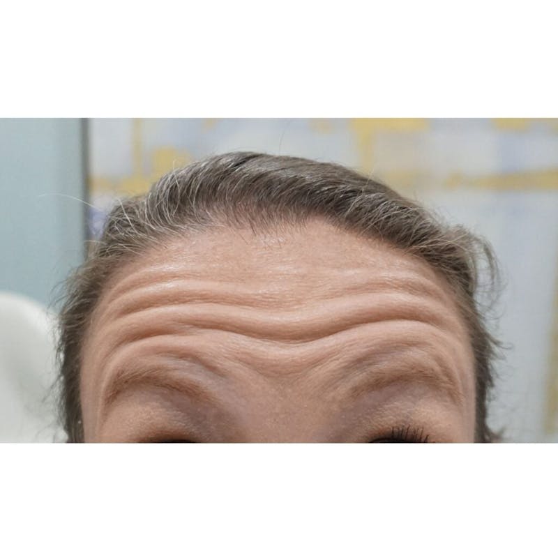 Injectables (BOTOX) Before & After Gallery - Patient 227738 - Image 1