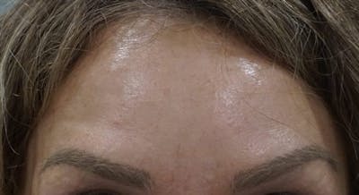 Injectables (BOTOX) Before & After Gallery - Patient 201415 - Image 2
