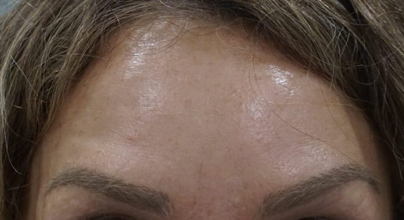Injectables (BOTOX) Before & After Gallery - Patient 201415 - Image 2