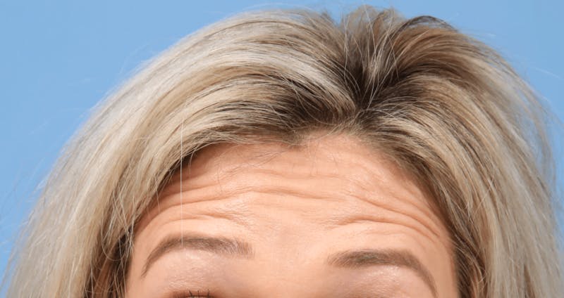 Injectables (BOTOX) Before & After Gallery - Patient 384242 - Image 1