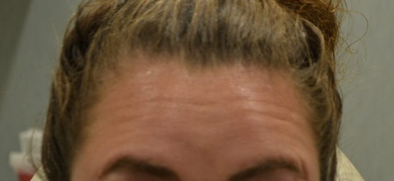 Injectables (BOTOX) Before & After Gallery - Patient 306137 - Image 1