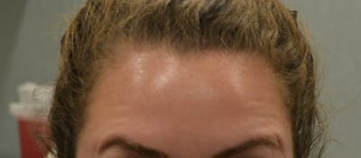 Injectables (BOTOX) Before & After Gallery - Patient 306137 - Image 2