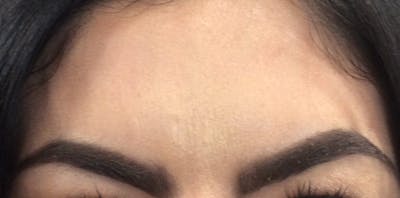 Injectables (BOTOX) Before & After Gallery - Patient 242495 - Image 2