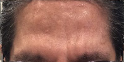 Injectables (BOTOX) Before & After Gallery - Patient 167272 - Image 2