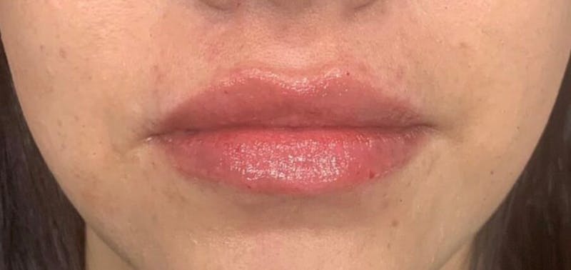 Injectables (Fillers) Before & After Gallery - Patient 244269 - Image 2