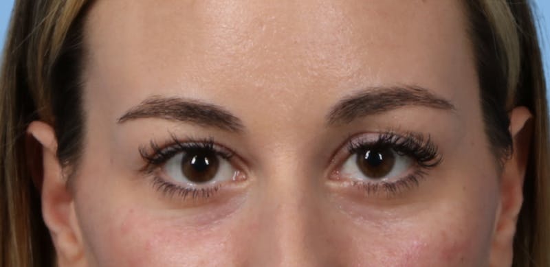 Injectables (Fillers) Before & After Gallery - Patient 223763 - Image 1