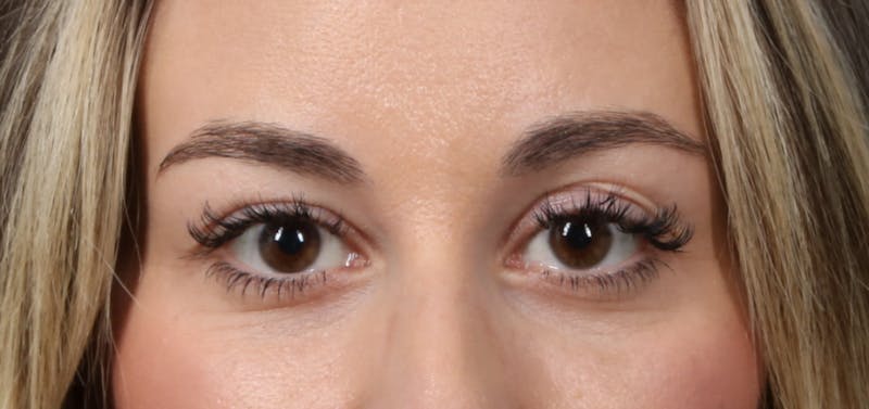 Injectables (Fillers) Before & After Gallery - Patient 223763 - Image 2