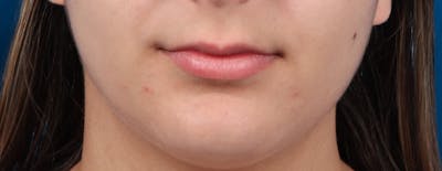 Injectables (Fillers) Before & After Gallery - Patient 131641 - Image 1