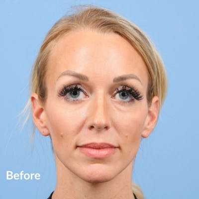 Injectables (Fillers) Before & After Gallery - Patient 139656 - Image 1