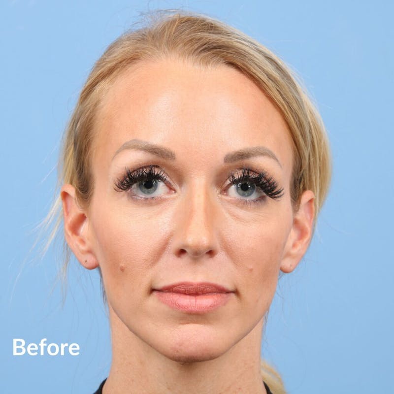 Injectables (Fillers) Before & After Gallery - Patient 139656 - Image 1