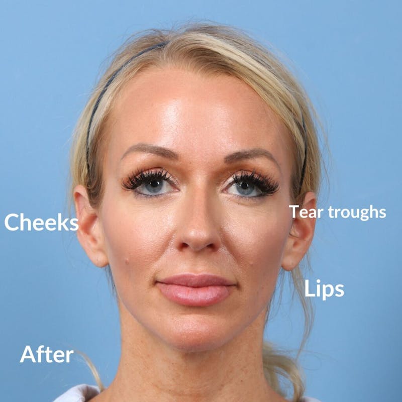 Injectables (Fillers) Before & After Gallery - Patient 139656 - Image 2