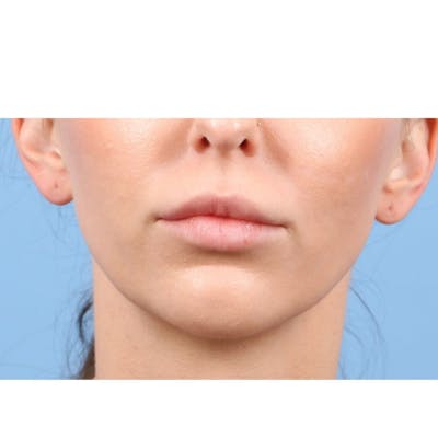 Injectables (Fillers) Before & After Gallery - Patient 352186 - Image 1