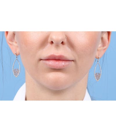 Injectables (Fillers) Before & After Gallery - Patient 352186 - Image 2