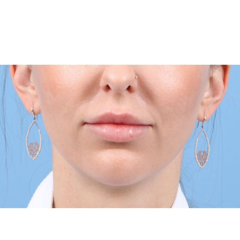 Injectables (Fillers) Before & After Gallery - Patient 352186 - Image 2