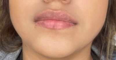 Injectables (Fillers) Before & After Gallery - Patient 389865 - Image 1