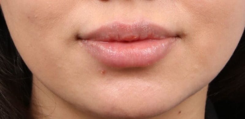 Injectables (Fillers) Before & After Gallery - Patient 370148 - Image 2