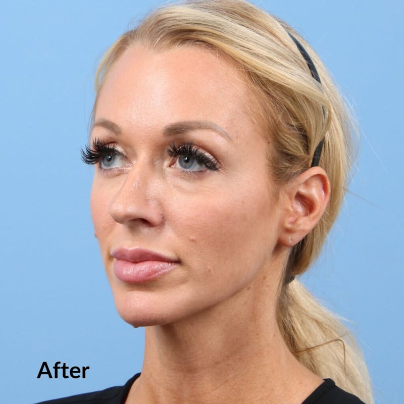 Injectables (Fillers) Before & After Gallery - Patient 146182 - Image 2