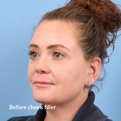 Injectables (Fillers) Before & After Gallery - Patient 353111 - Image 1
