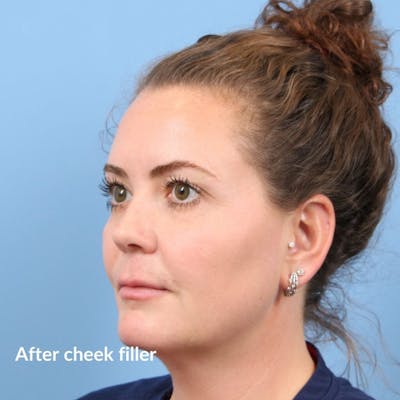 Injectables (Fillers) Before & After Gallery - Patient 353111 - Image 2