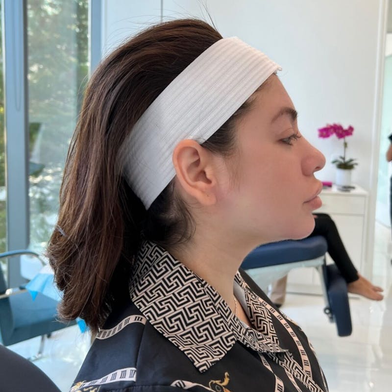Injectables (Fillers) Before & After Gallery - Patient 636381 - Image 1