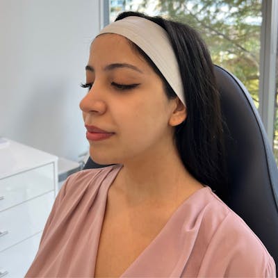 Injectables (Fillers) Before & After Gallery - Patient 192972 - Image 1