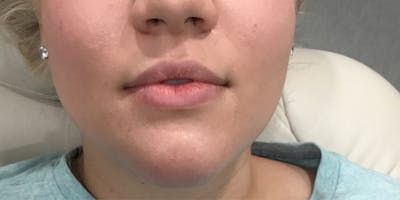 Injectables (Fillers) Before & After Gallery - Patient 170466 - Image 1