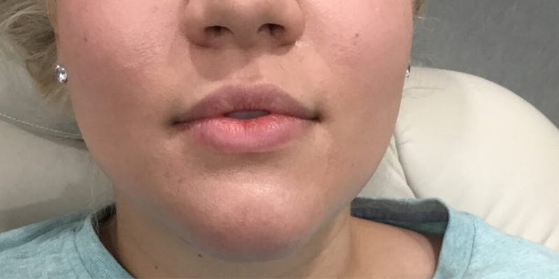 Injectables (Fillers) Before & After Gallery - Patient 170466 - Image 1