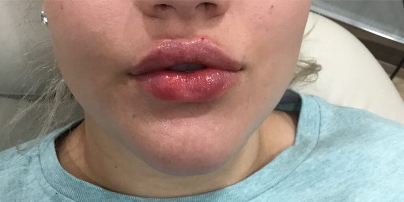 Injectables (Fillers) Before & After Gallery - Patient 170466 - Image 2