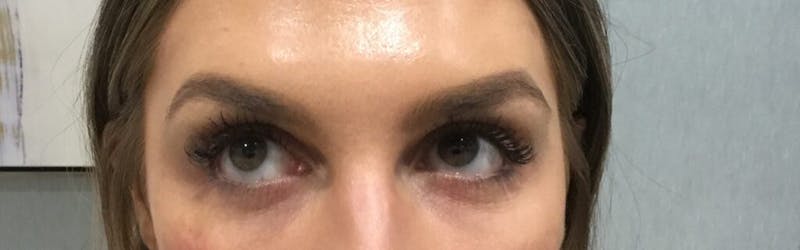 Injectables (Fillers) Before & After Gallery - Patient 236104 - Image 2