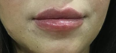 Injectables (Fillers) Before & After Gallery - Patient 411118 - Image 2
