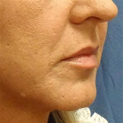 Injectables (Fillers) Before & After Gallery - Patient 181438 - Image 2