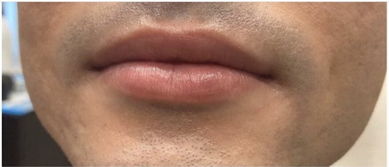 Lip Enhancement Before & After Gallery - Patient 752687 - Image 1