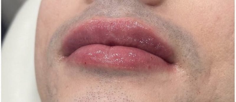 Lip Enhancement Before & After Gallery - Patient 752687 - Image 2