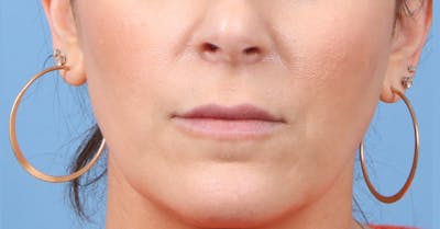 Lip Enhancement Before & After Gallery - Patient 230786 - Image 1