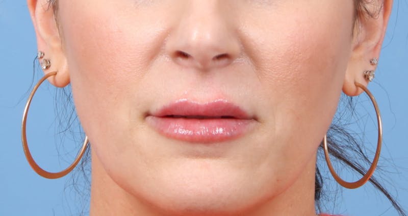 Lip Enhancement Before & After Gallery - Patient 230786 - Image 2