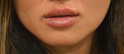 Lip Enhancement Before & After Gallery - Patient 412627 - Image 2