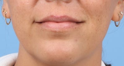 Lip Enhancement Before & After Gallery - Patient 487801 - Image 1