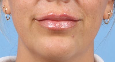 Lip Enhancement Before & After Gallery - Patient 487801 - Image 2
