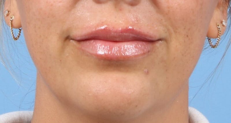 Lip Enhancement Before & After Gallery - Patient 487801 - Image 2