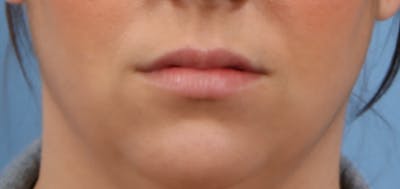 Lip Enhancement Before & After Gallery - Patient 546584 - Image 1
