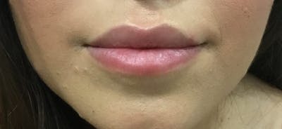 Lip Enhancement Before & After Gallery - Patient 331539 - Image 1