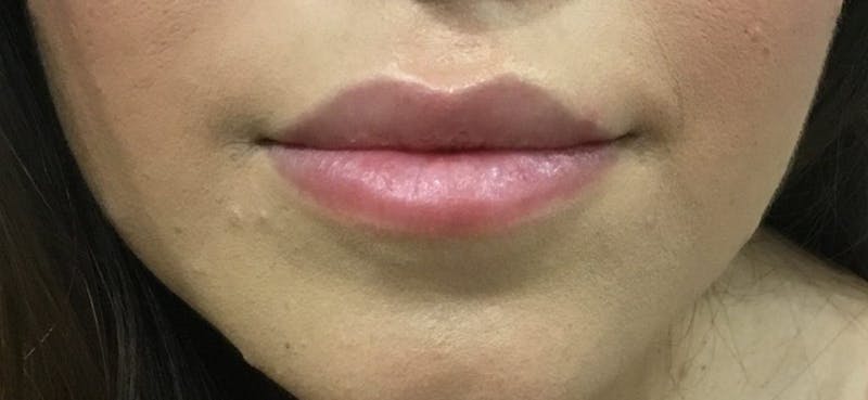Lip Enhancement Before & After Gallery - Patient 331539 - Image 1