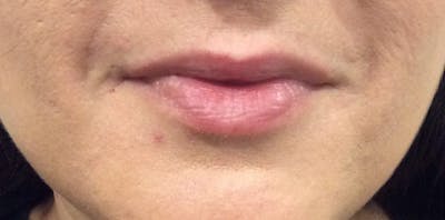 Lip Enhancement Before & After Gallery - Patient 206404 - Image 1