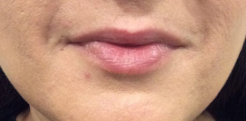 Lip Enhancement Before & After Gallery - Patient 206404 - Image 1