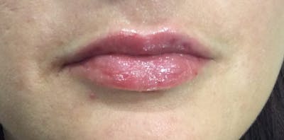 Lip Enhancement Before & After Gallery - Patient 206404 - Image 2