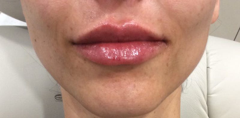 Lip Enhancement Before & After Gallery - Patient 159836 - Image 2
