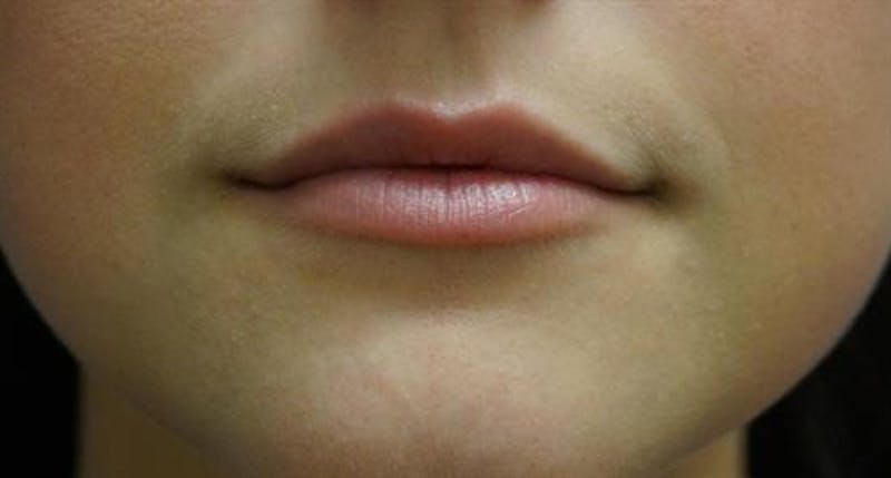 Lip Enhancement Before & After Gallery - Patient 370906 - Image 1