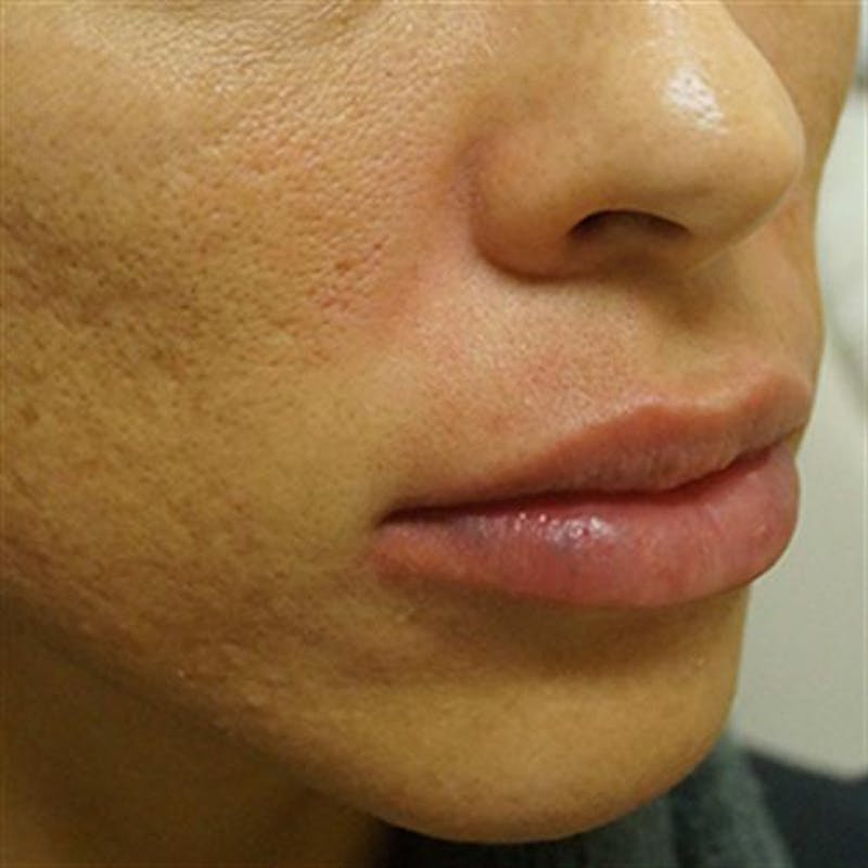 Lip Enhancement Before & After Gallery - Patient 119269 - Image 2