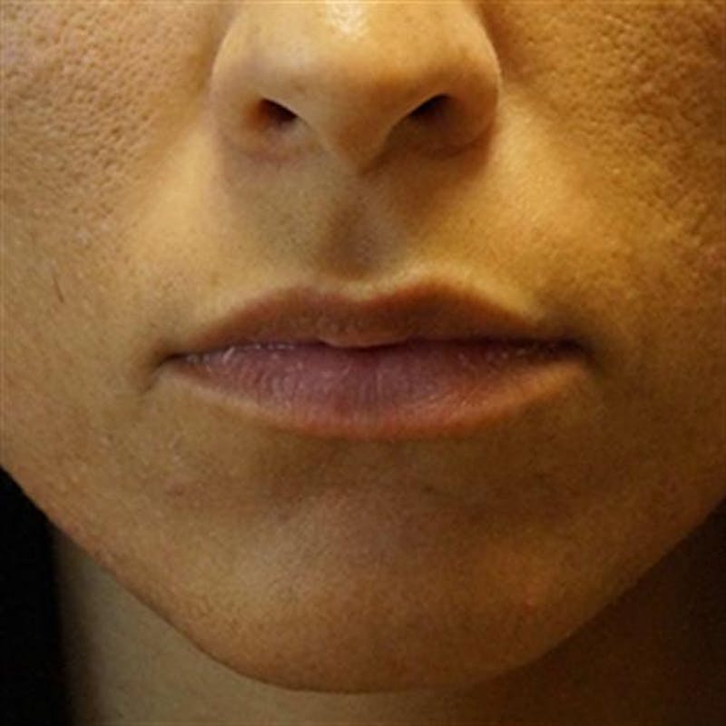 Lip Enhancement Before & After Gallery - Patient 149336 - Image 1