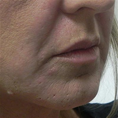Lip Enhancement Before & After Gallery - Patient 130694 - Image 1